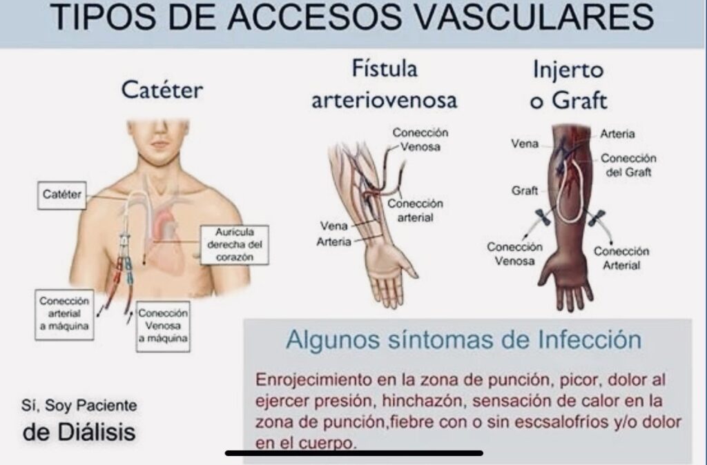 tipos de accesos vasculares